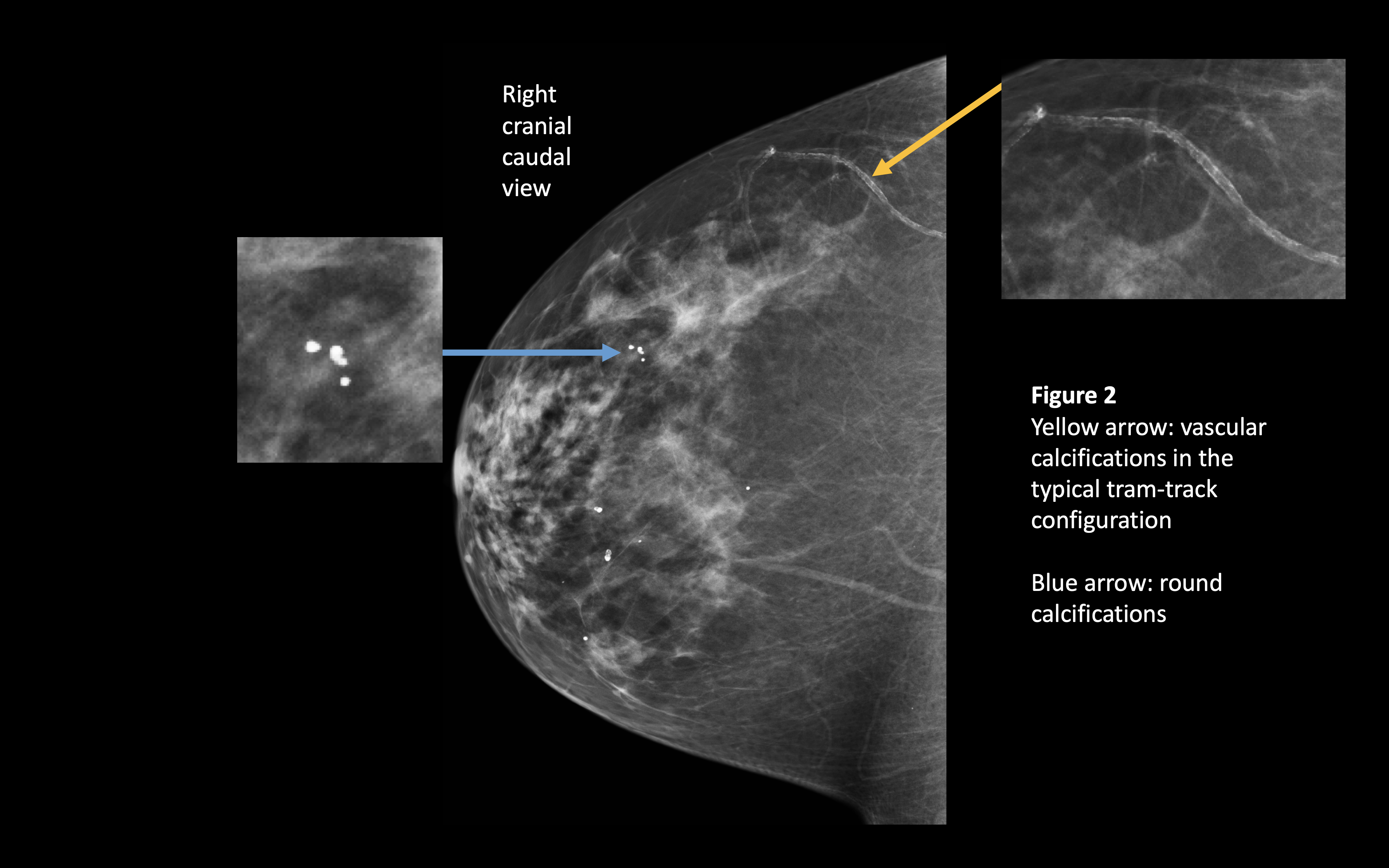 vascular and round calcifications