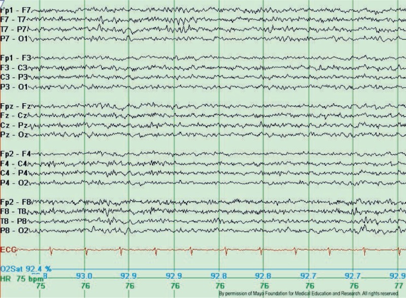 <p>Typical Wicket Waves