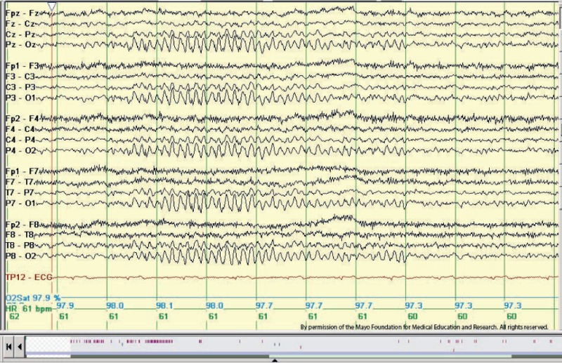 <p>Phantom Spike and Wave