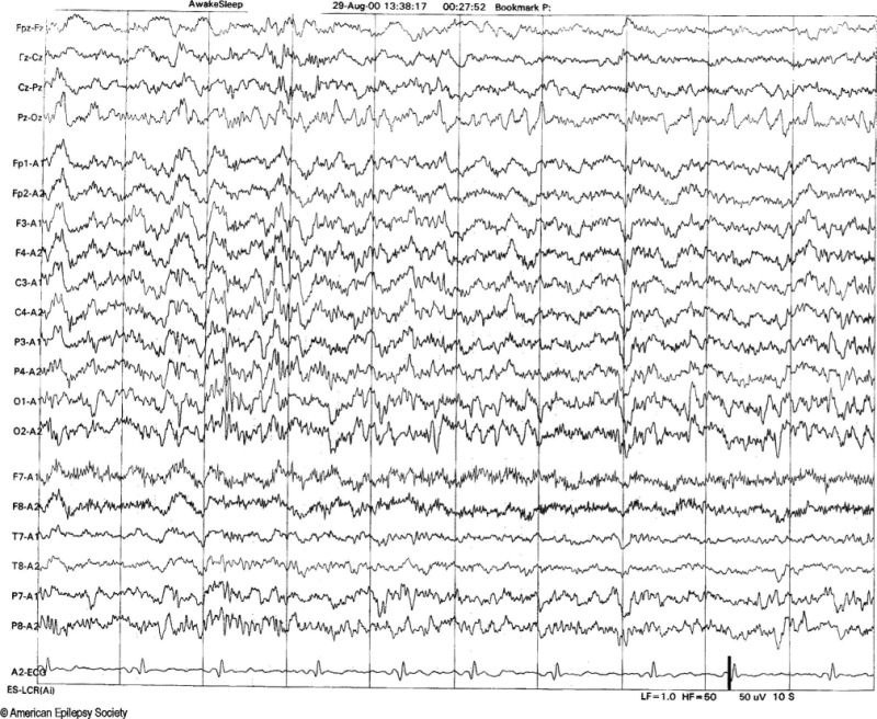 <p>Positive Spiky Waveforms