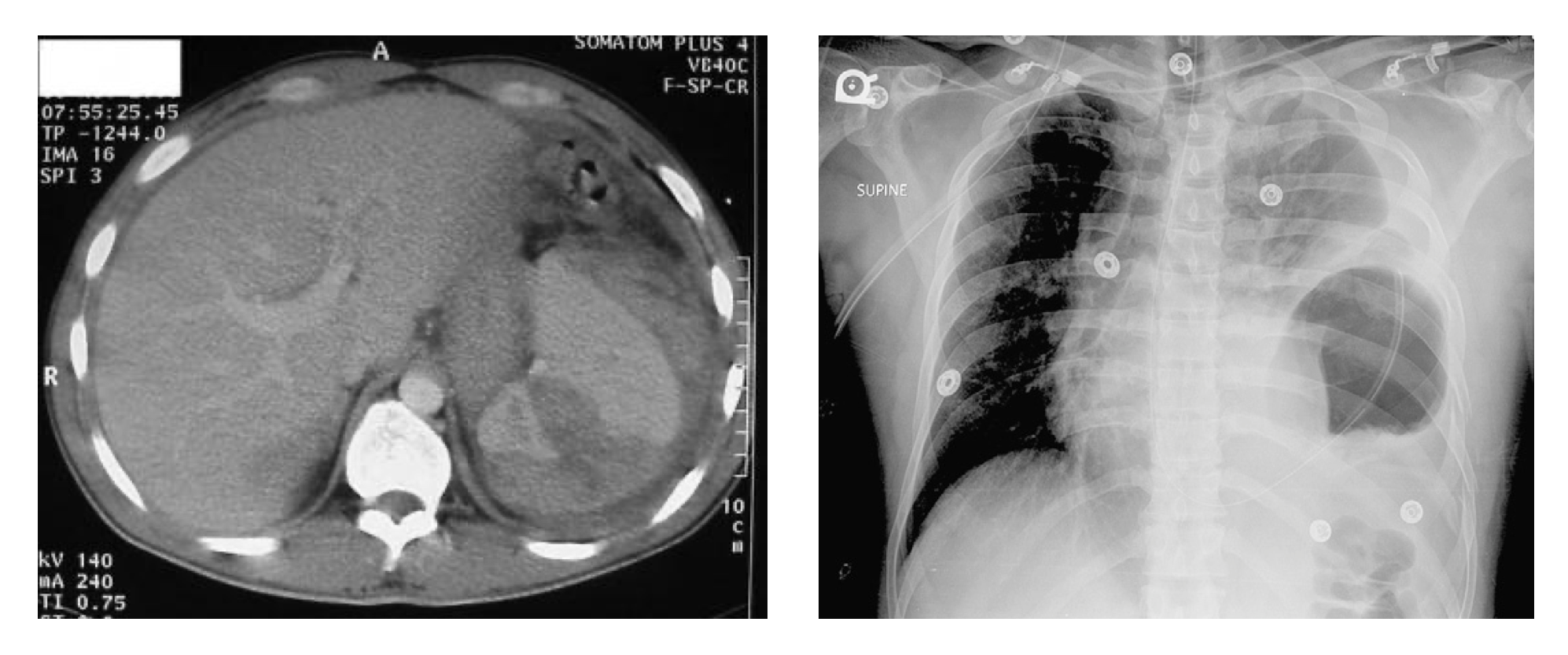 CT scan of a grade IV-V splenic injury. CXR suggests a left hemidiaphragm rupture.