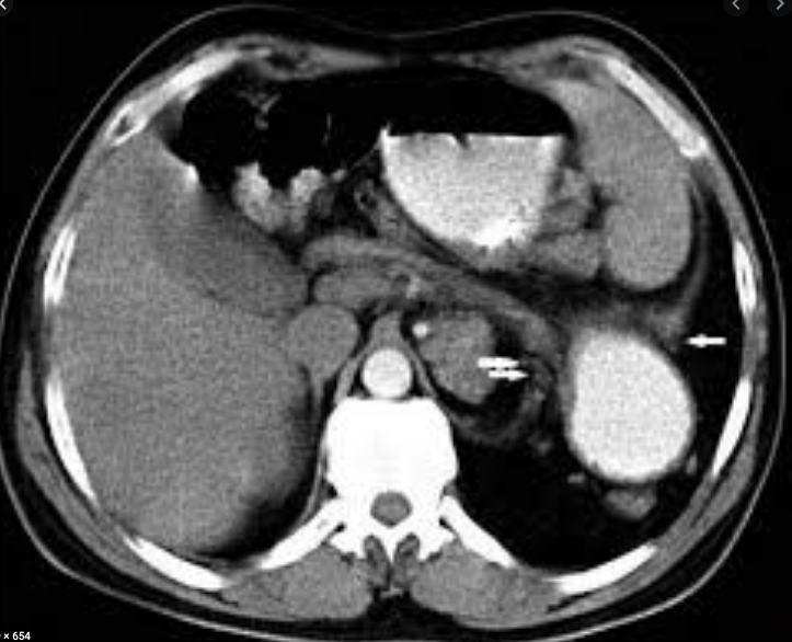 <p>Delayed Diaphragmatic Hernia. A delayed diaphragmatic hernia is seen on computed tomography imaging.</p>