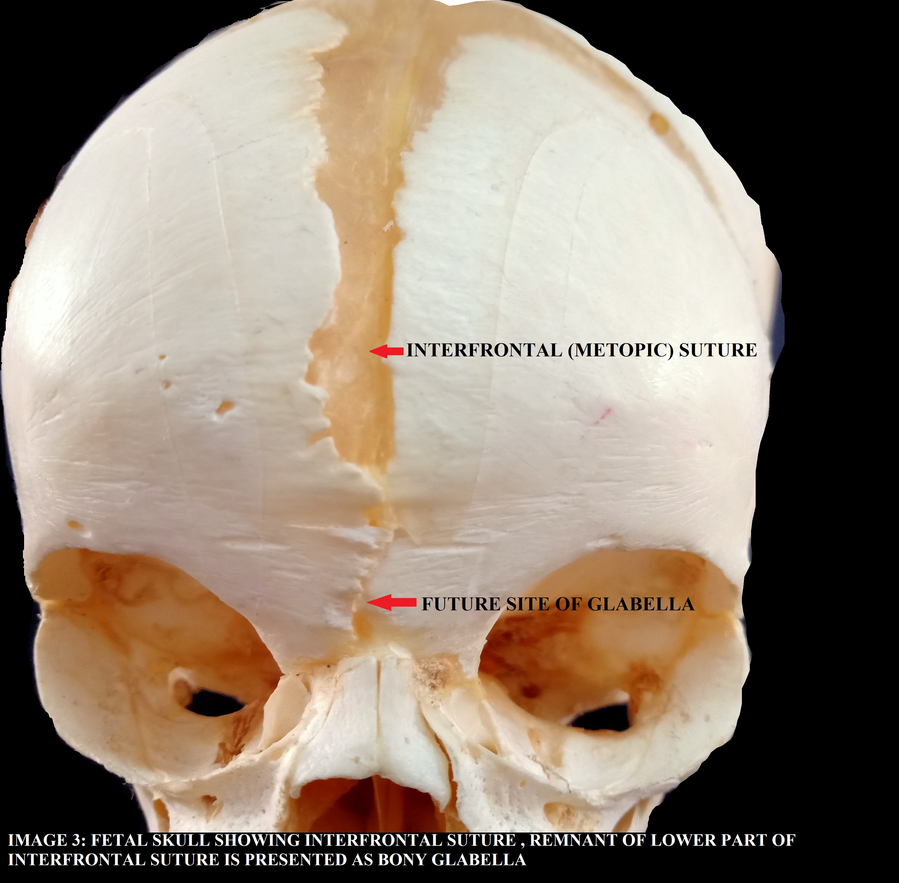 INTERFRONTAL (METOPIC) SUTURE AND FUTURE SITE OF GLABELLA IN FETAL SKULL