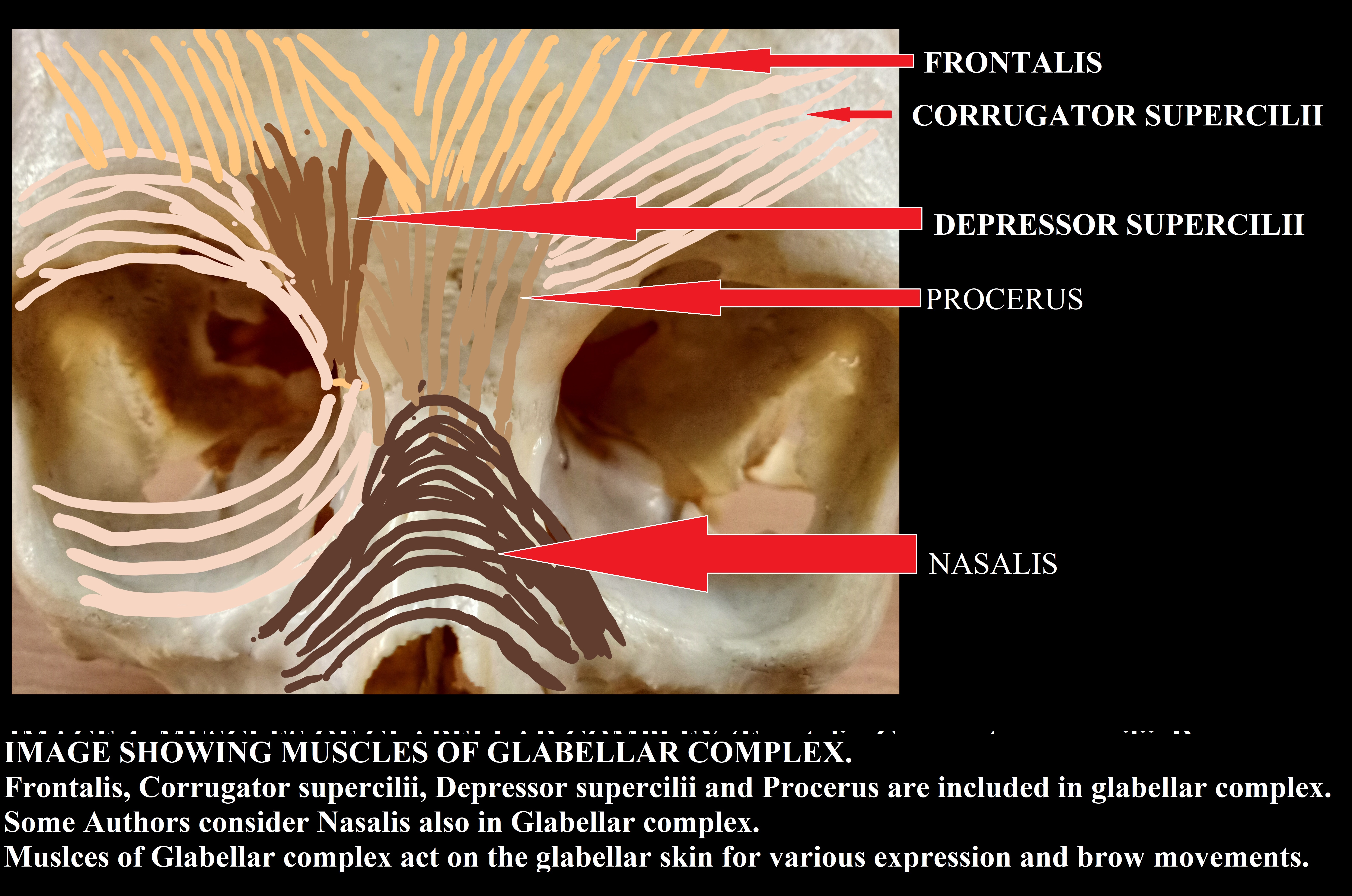 SCHEMATIC DIAGRAM SHOWING MUSCLE OF GLABELLAR COMPLEX