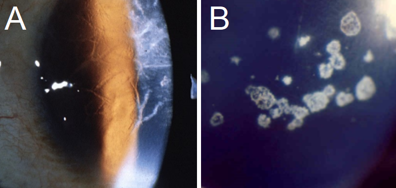 A: Typical branching opacities found in Lattice Corneal Dystrophy