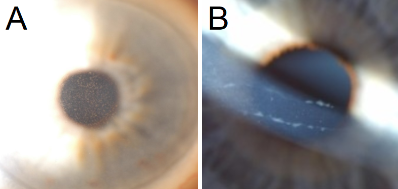 A: Central guttae are noted centrally in this patient with Fuchs Endothelial Corneal Dystrophy