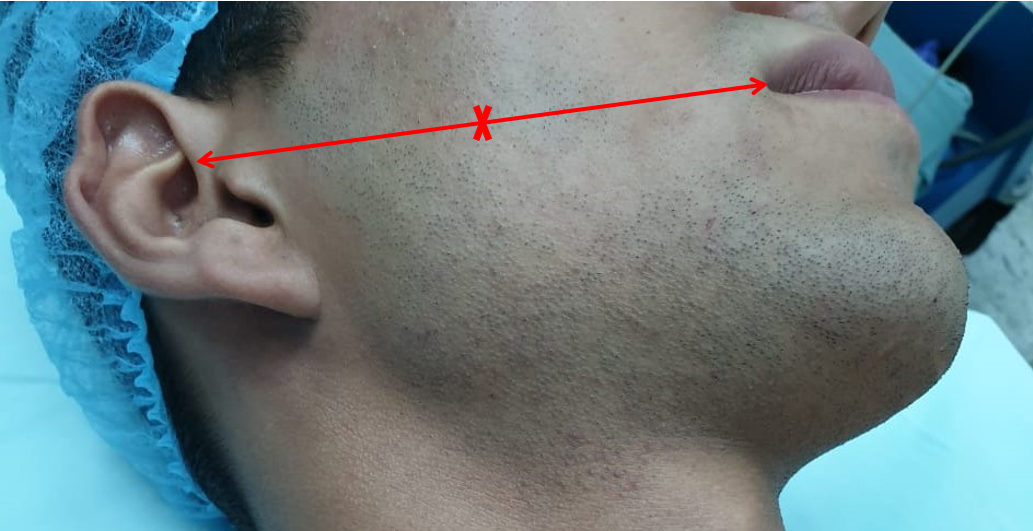 The middle branch of the facial nerve (zygomatic/buccal) can be identified at Zuker’s point that lies midway on a line drawn 