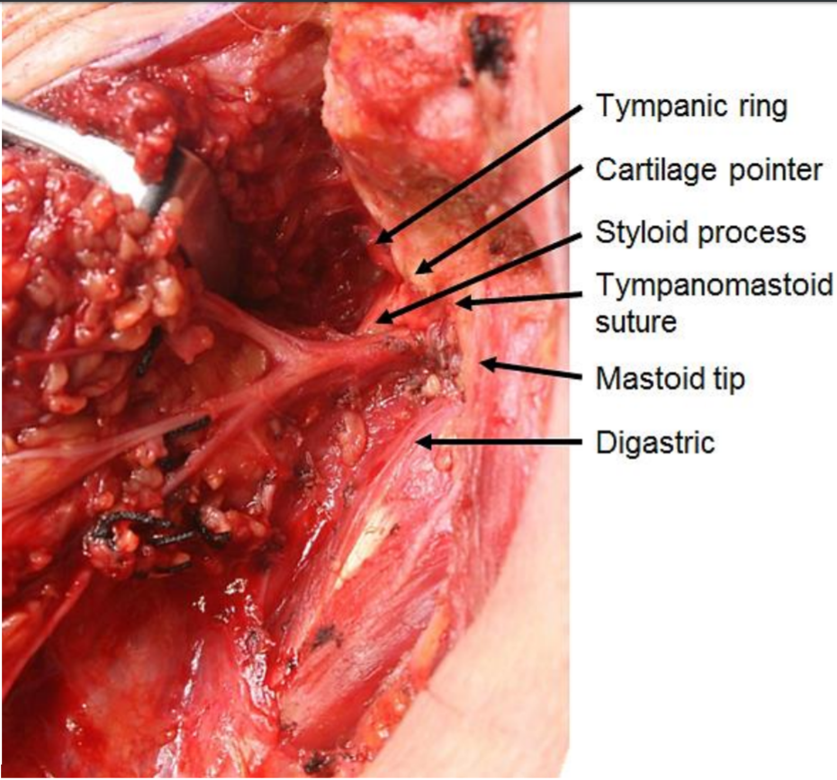 <p>Surgical Landmarks for the Main Trunk of the Facial Nerve