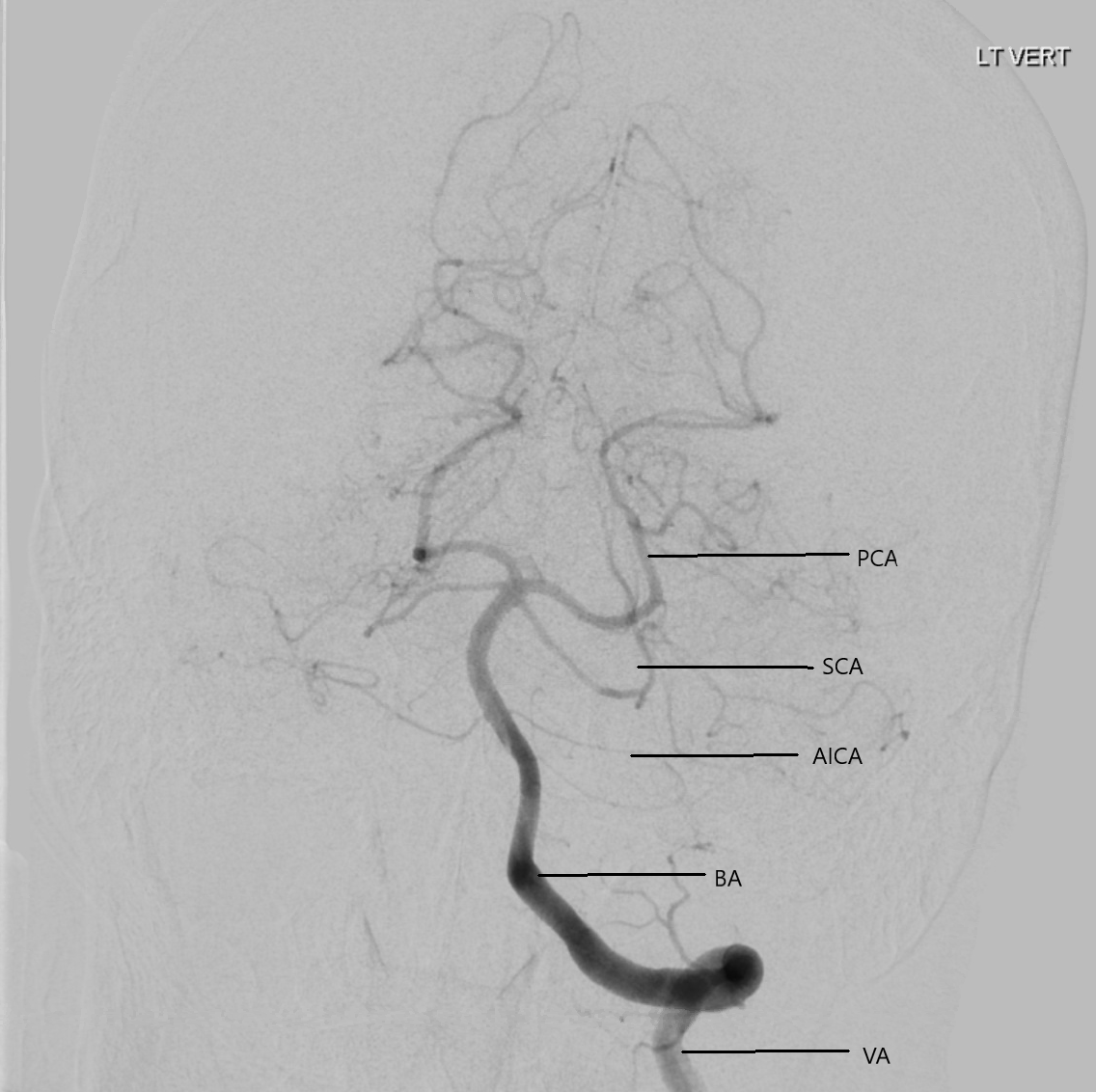 Digital Subtraction Angiogram of the left vertebral artery. PCA - posterior cerebral artery, SCA - superior cerebellar artery, AICA - anterior inferior cerebellar artery, BA - basilar artery, VA - vertebral artery