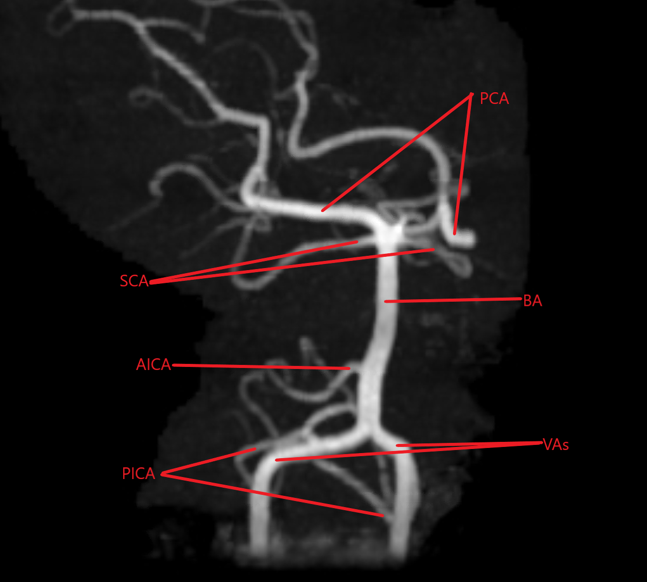 Magnetic Resonance Angiogram of the posterior circulation. PCA (posterior circulation arteries), SCA (superior cerebellar arteries), BA (basilar artery), AICA (right anterior inferior cerebellar artery), VAs (vertebral arteries), PICA (posterior inferior cerebellar arteries