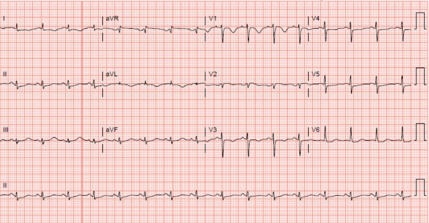 Mid-Ventricular Cardiomyopathy