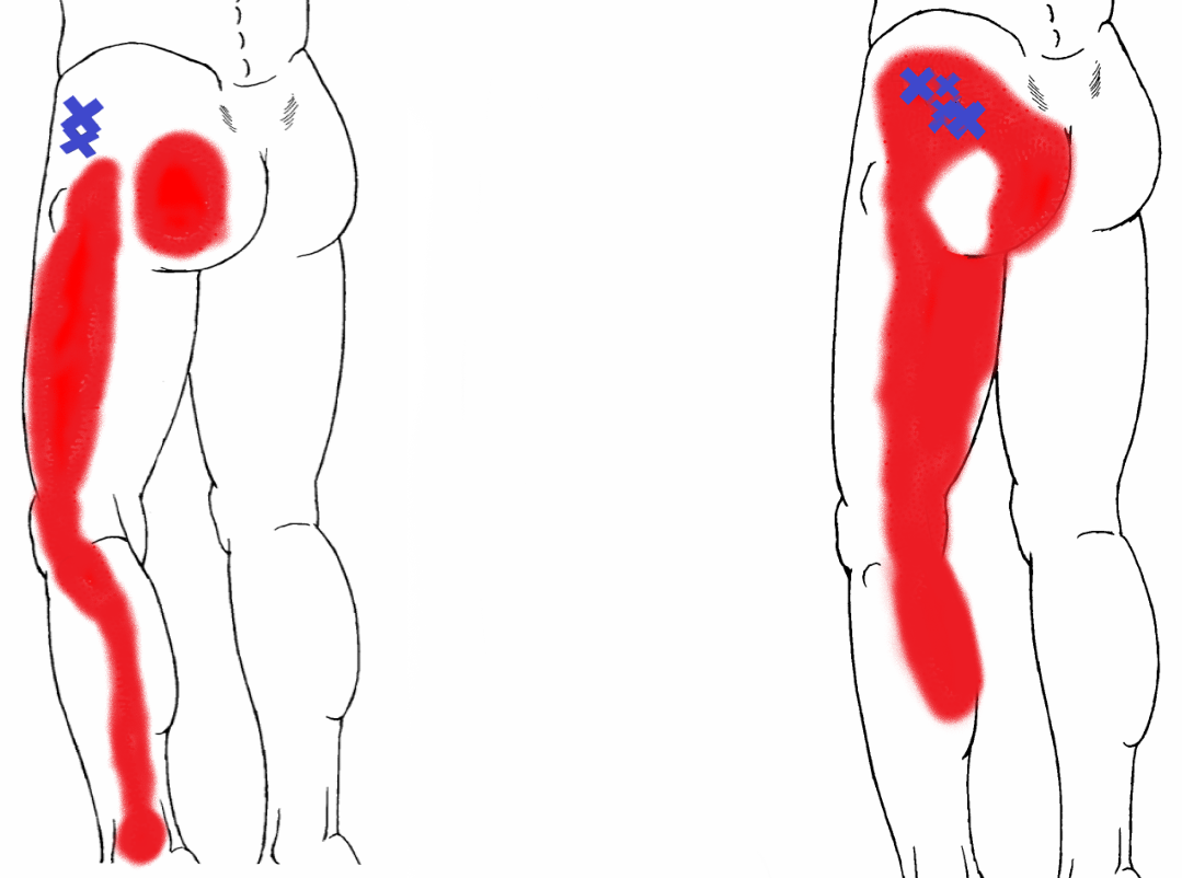 Most common Trigger Points at the Gluteus Minimus muscle.