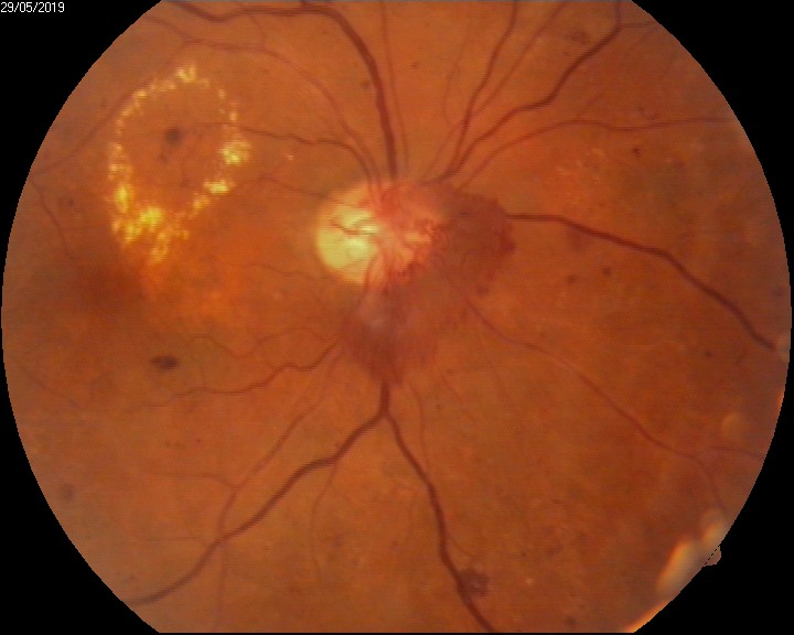 diabetic retinopathy- neovascularisation of disc (NVD)