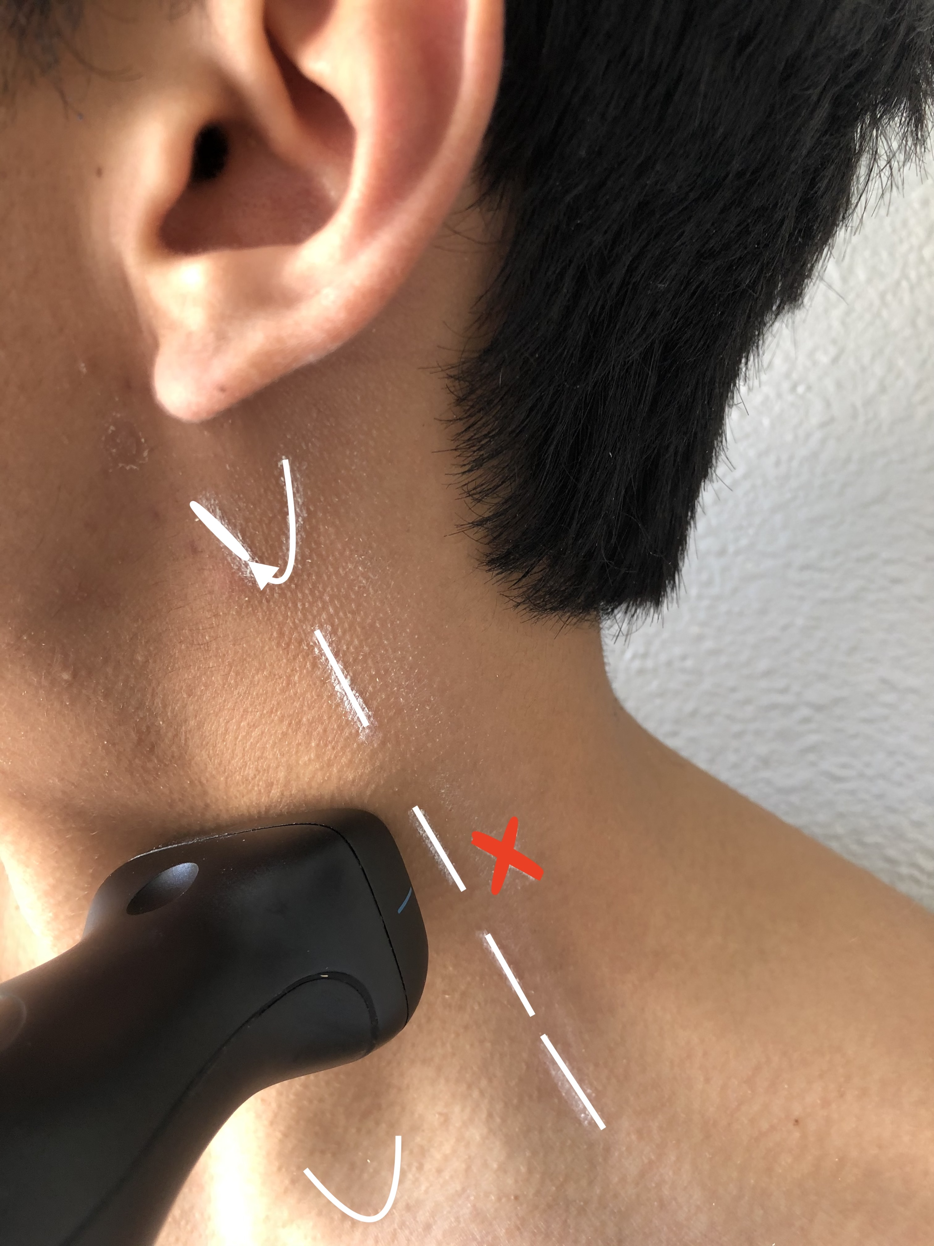 Correct placement of probe at the middle of the posterior border of the sternocleidomastoid muscle for a superficial cervical plexus block.  Inserting the needle at the point marked by the red X positions it correctly in the initial step of the procedure.