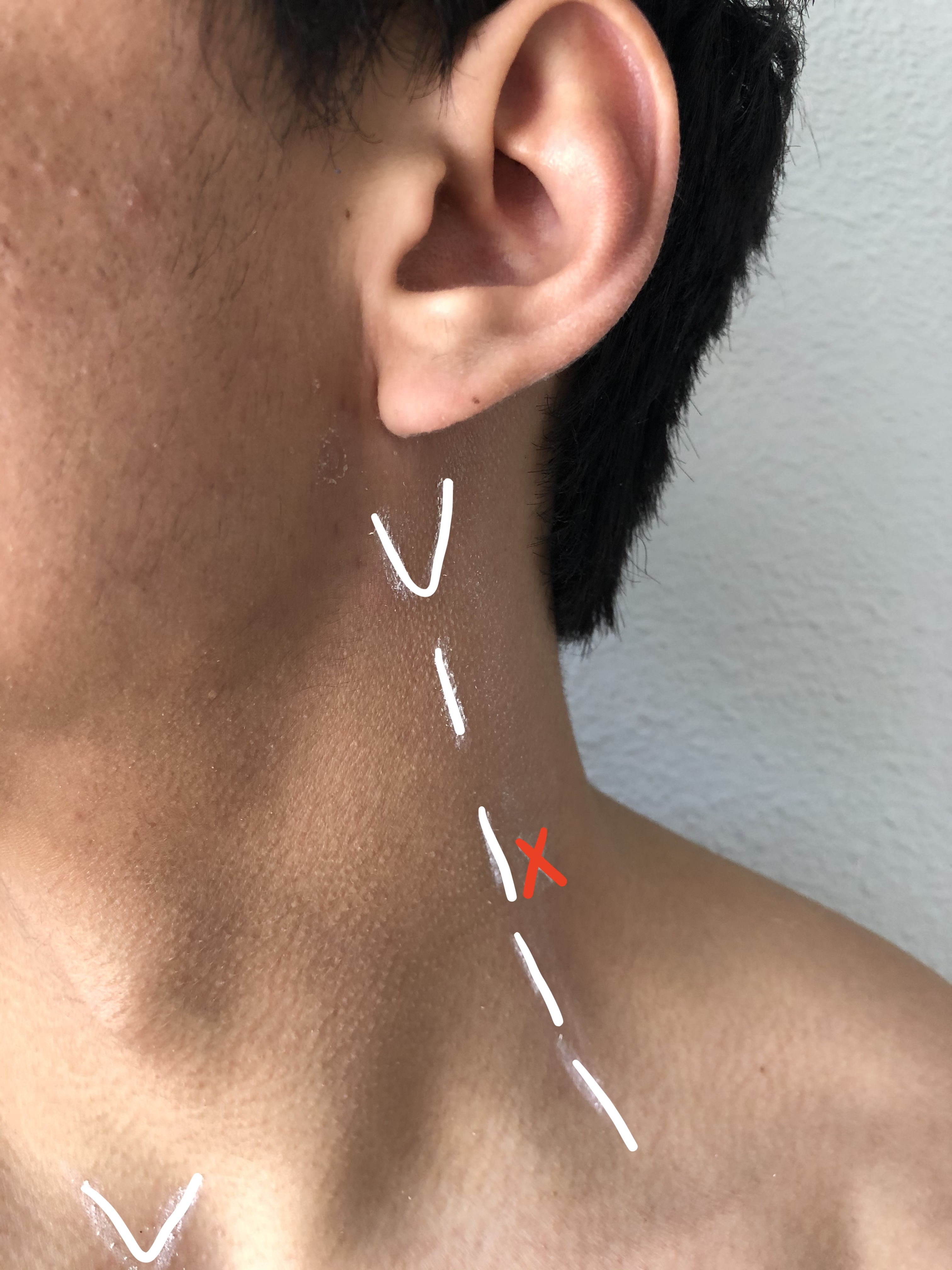 The white "V" inferior to earlobe is over the mastoid process. The dotted line is the posterior border of the sternocleidomastoid muscle. The red "X" is the mid-point where the block needle is inserted. The midline "V" is over the sternal notch.  This approximates the inferior aspect of the sternocleidomastoid muscle.