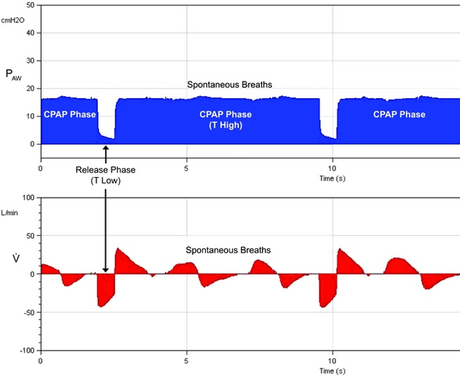 <p>APRV Pressure Cycles With Superimposed Spontaneous Breathing