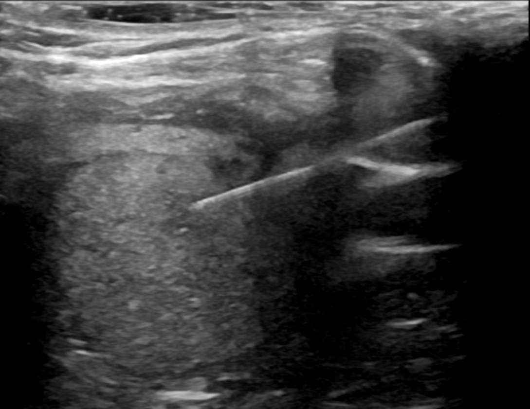 Figure 1: An isoechoic nodule is appreciated within the left thyroid lobe