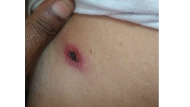 Fig 1: Eschar over the right chest produced after the bite of a chigger in a farmer