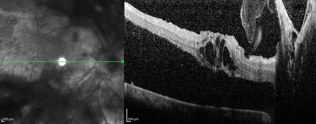 <p>Proliferative Diabetic Retinopathy OCT