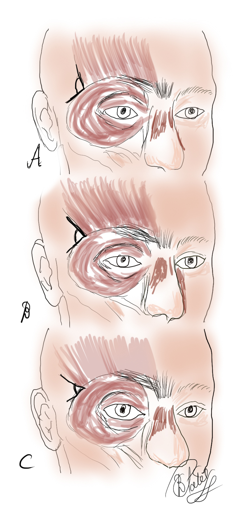 <p>The Frontalis Muscle