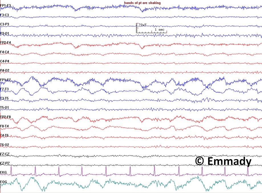 Nonepileptic seizures, hands shaking, lateral eye movements