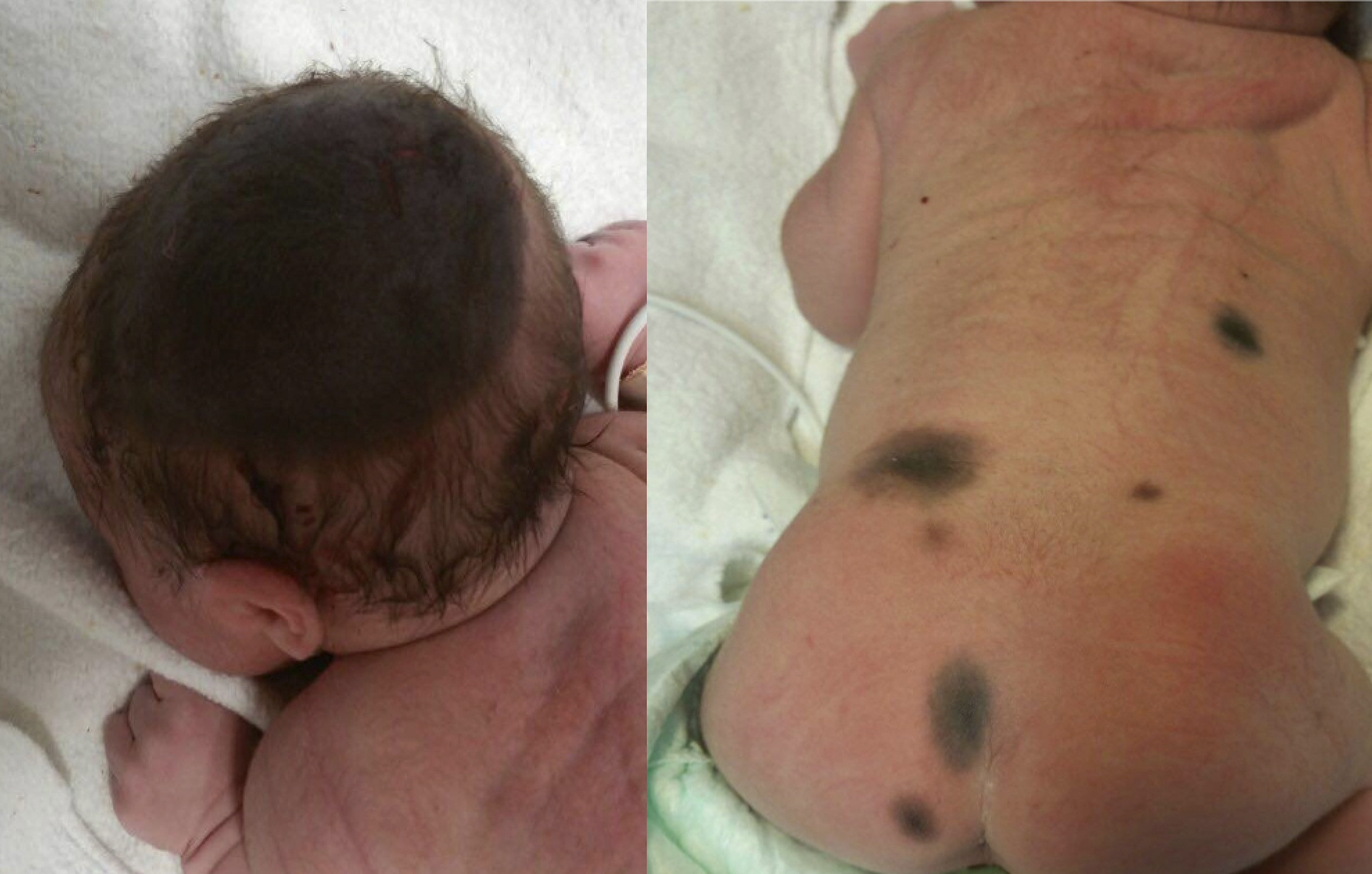 <p>Giant Congenital Melanocytic Nevus in Newborn