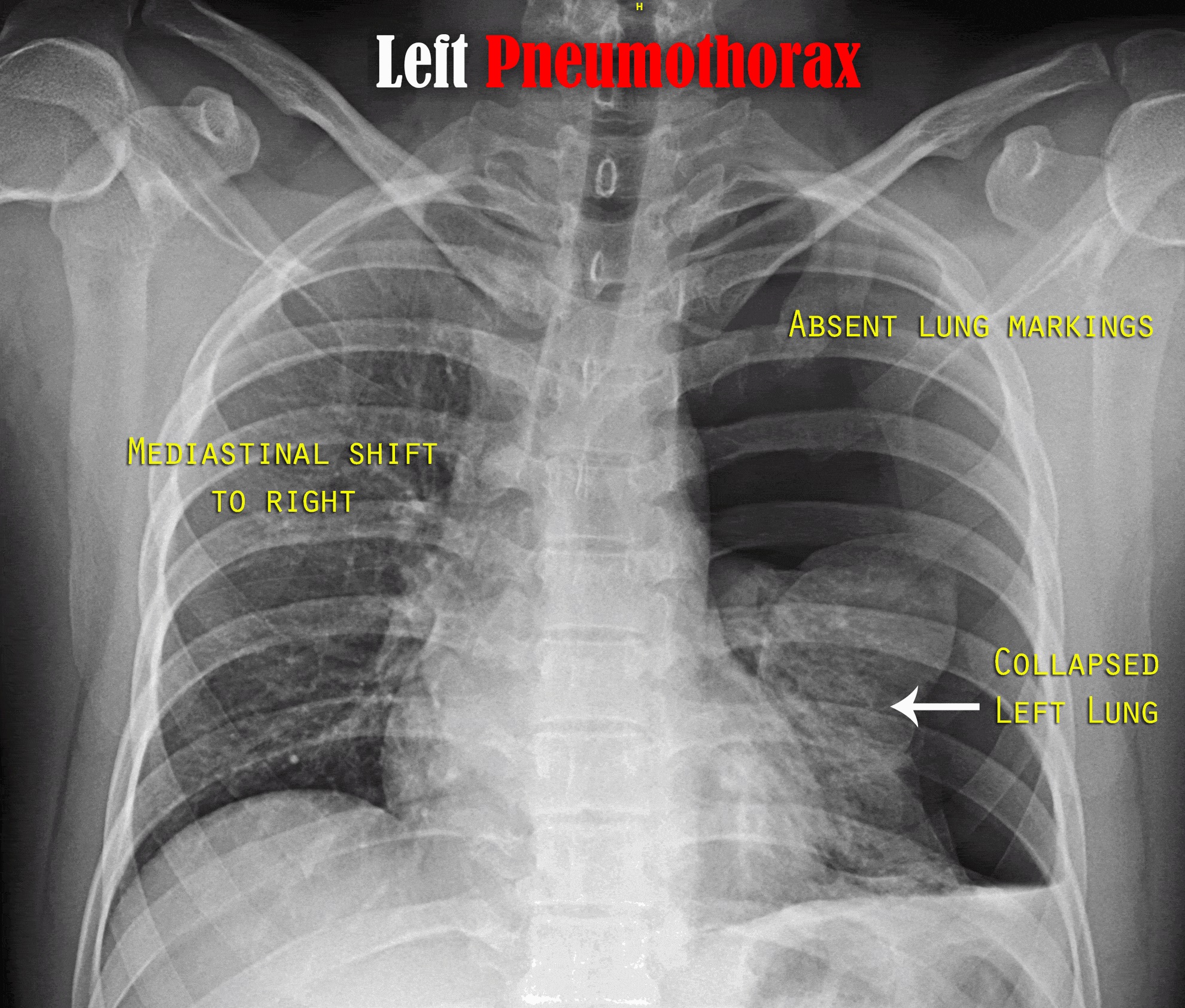 left sided tension pneumothorax