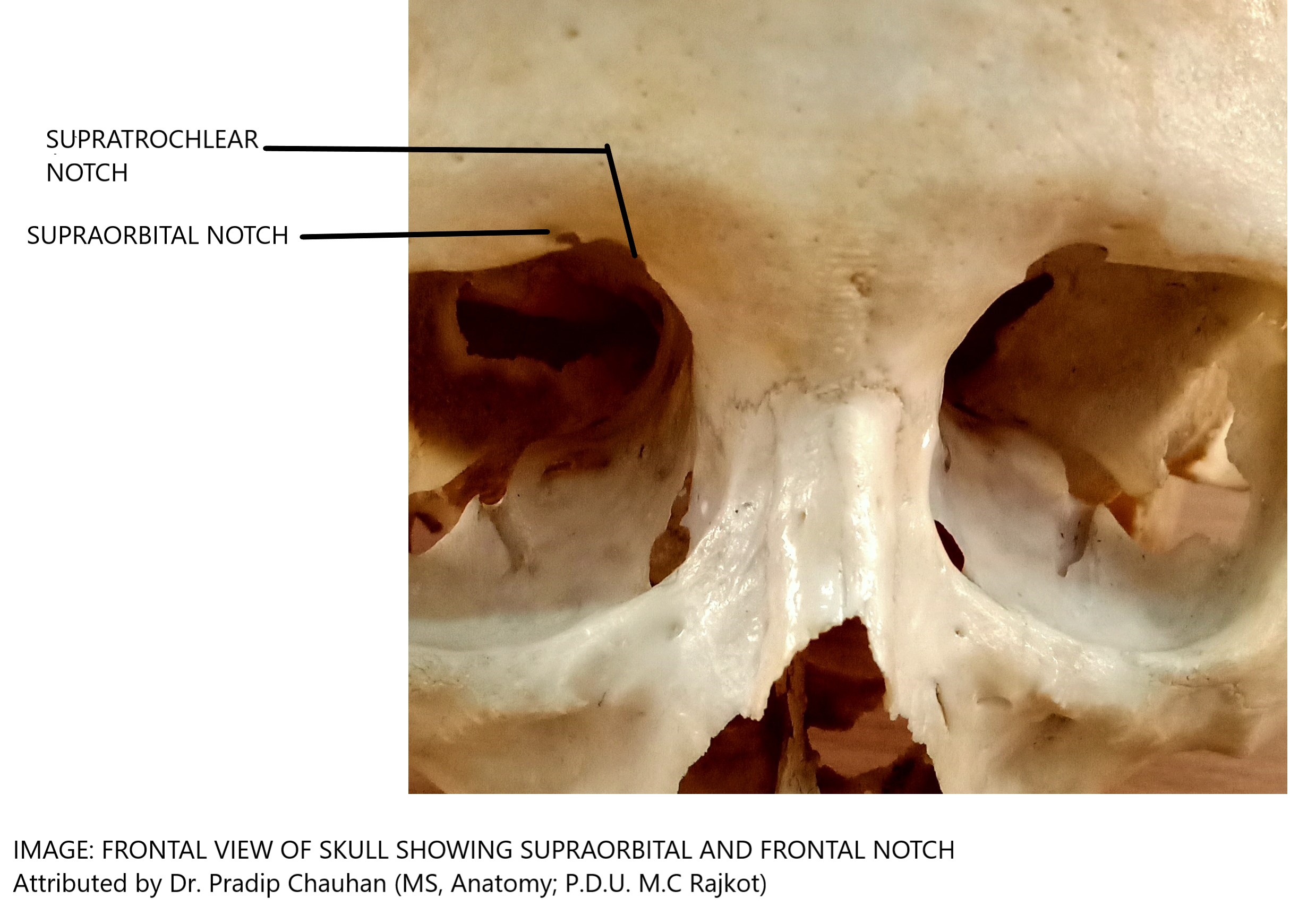 FRONTAL VIEW OF THE SKULL SHOWING SUPRATROCHLEAR AND SUPRAORBITAL NOTCH