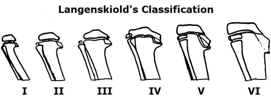 <p>Langenski&ouml;ld Classification System