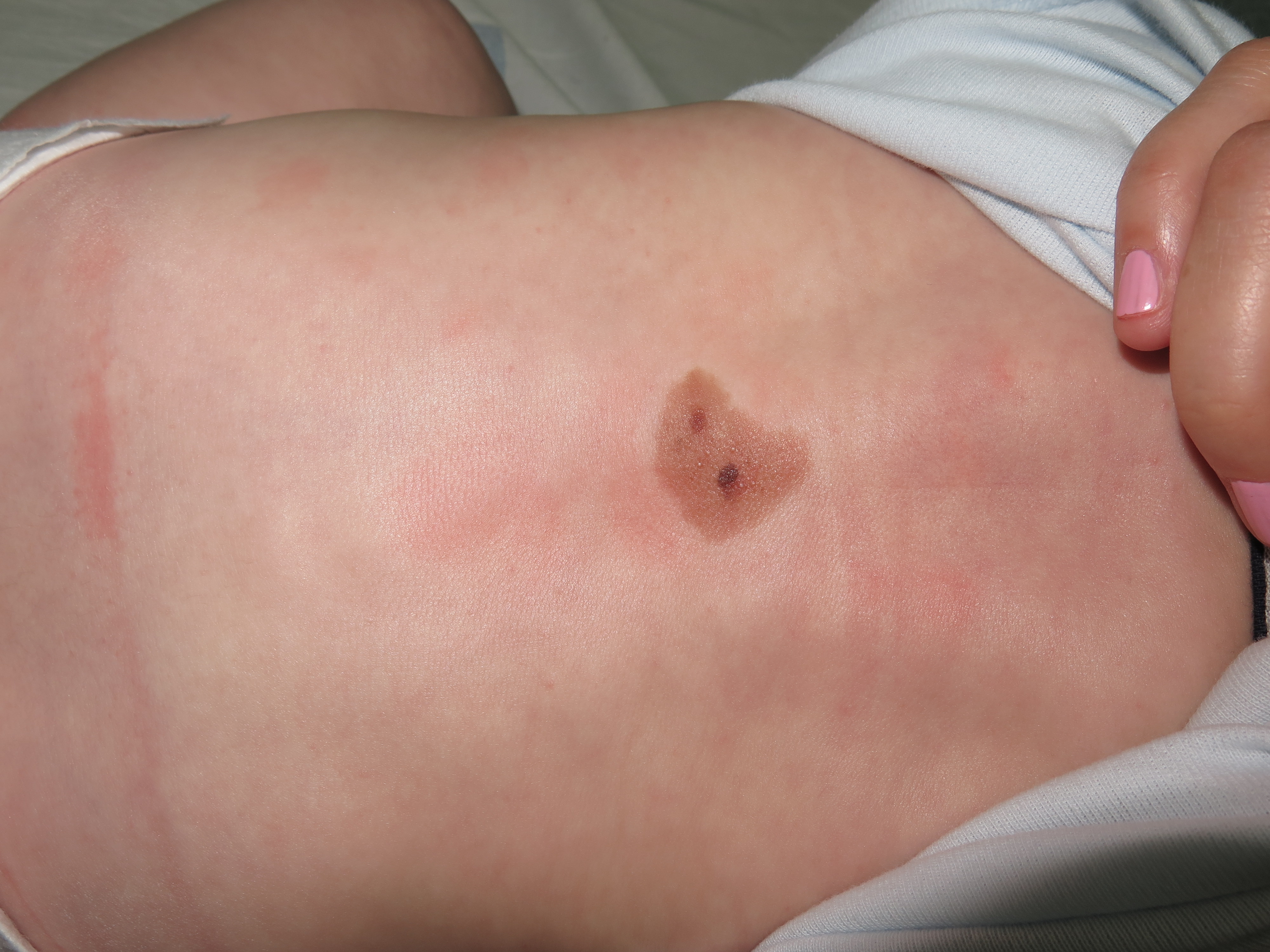 <p>Medium-Sized Congenital Melanocytic Nevus on Infant's Back