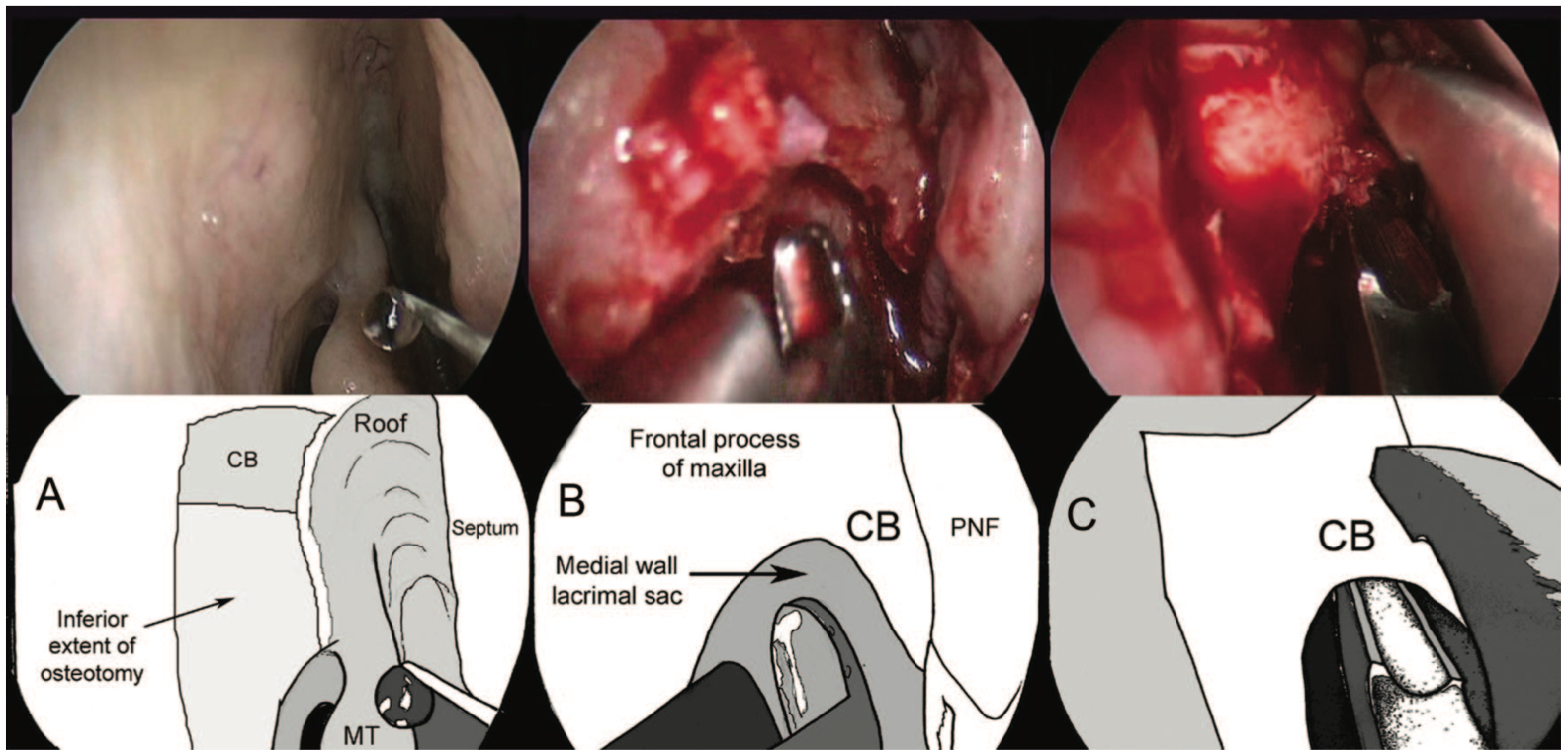 Bony Osteotomy in an Endoscopic Dacryocystorhinostomy: A, The right lateral nasal wall prior to surgery with a schematic illustration showing the underlying position of the osteot-
omy. The ceiling beam will overlie the fundus of the lacrimal sac, and removal of its full extent was facilitated by the nibbler. B, Fur- ther bone work with the up-biting punch is becoming difficult due to bone orientation and angulation. C, Further removal of the ceiling beam was achieved with the nibbler. CB, ceiling beam; PNF, posterior nasal flap; MT, middle turbinate.