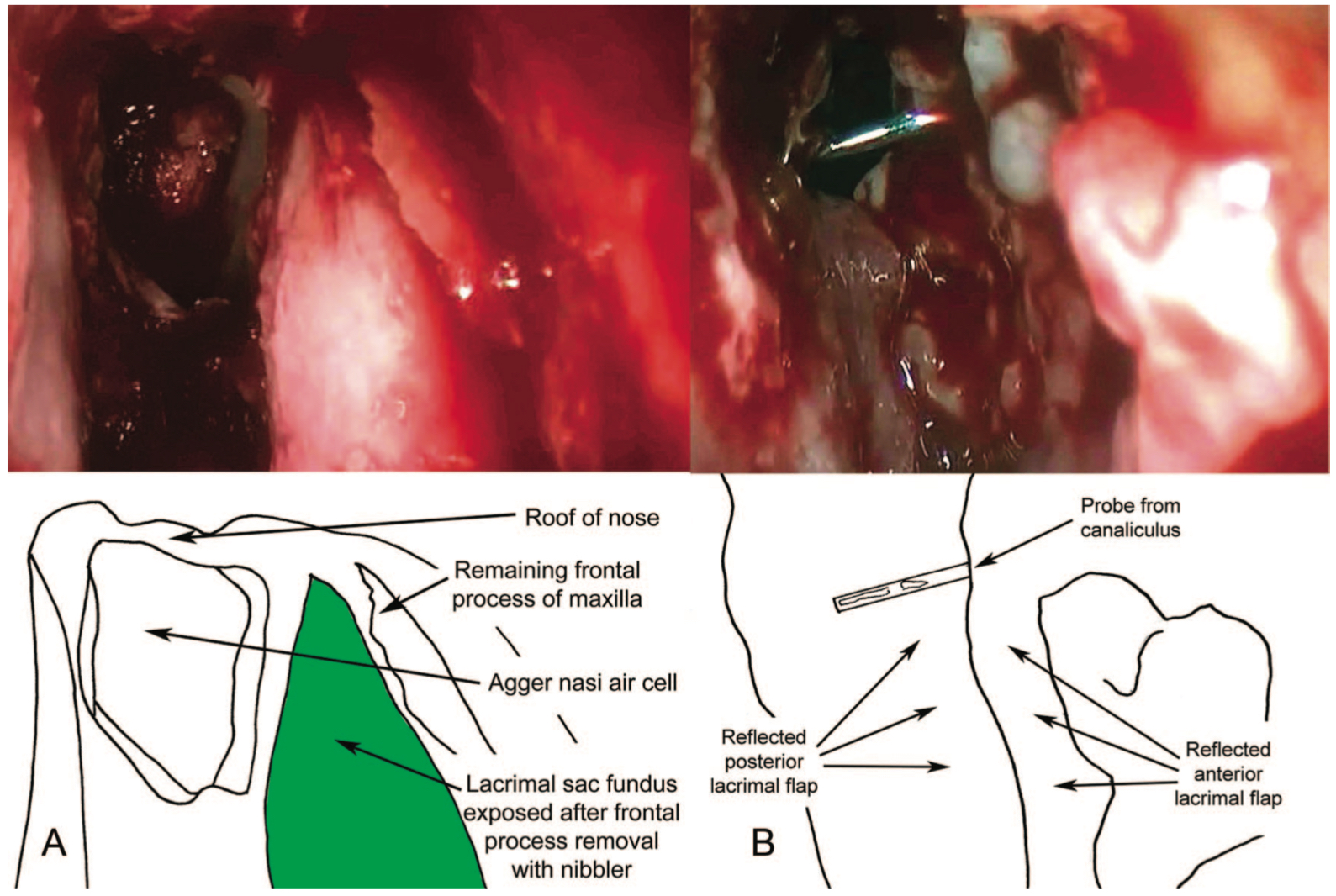 Endoscopic Dacryocystorhinostomy: A view of the lateral wall of the left nasal cavity showing full exposure of the lacrimal sac (A) and marsupialization of the lacrimal sac (B). The flaps should lie flat on the nasal wall like the pages of an open book, with no tendency towards closure (B).