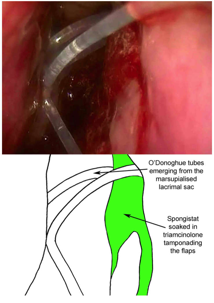 Endoscopic Dacryocystorhinostomy: placement of O'Donoghue Silicone stent