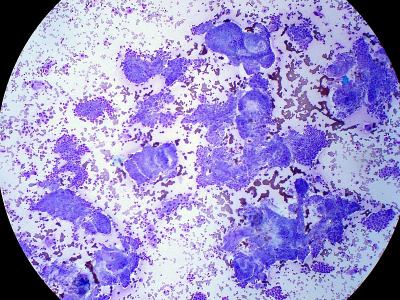 <p>Papillary Thyroid Carcinoma, FNA Giemsa Stain.</p>