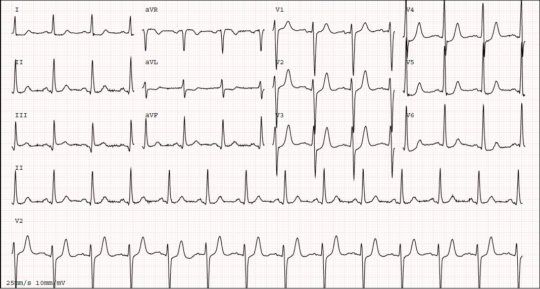 <p>The de Winter ECG Pattern.&nbsp;</p>