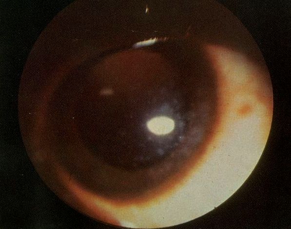 Snow flake keratitis associated with Onchocerciasis