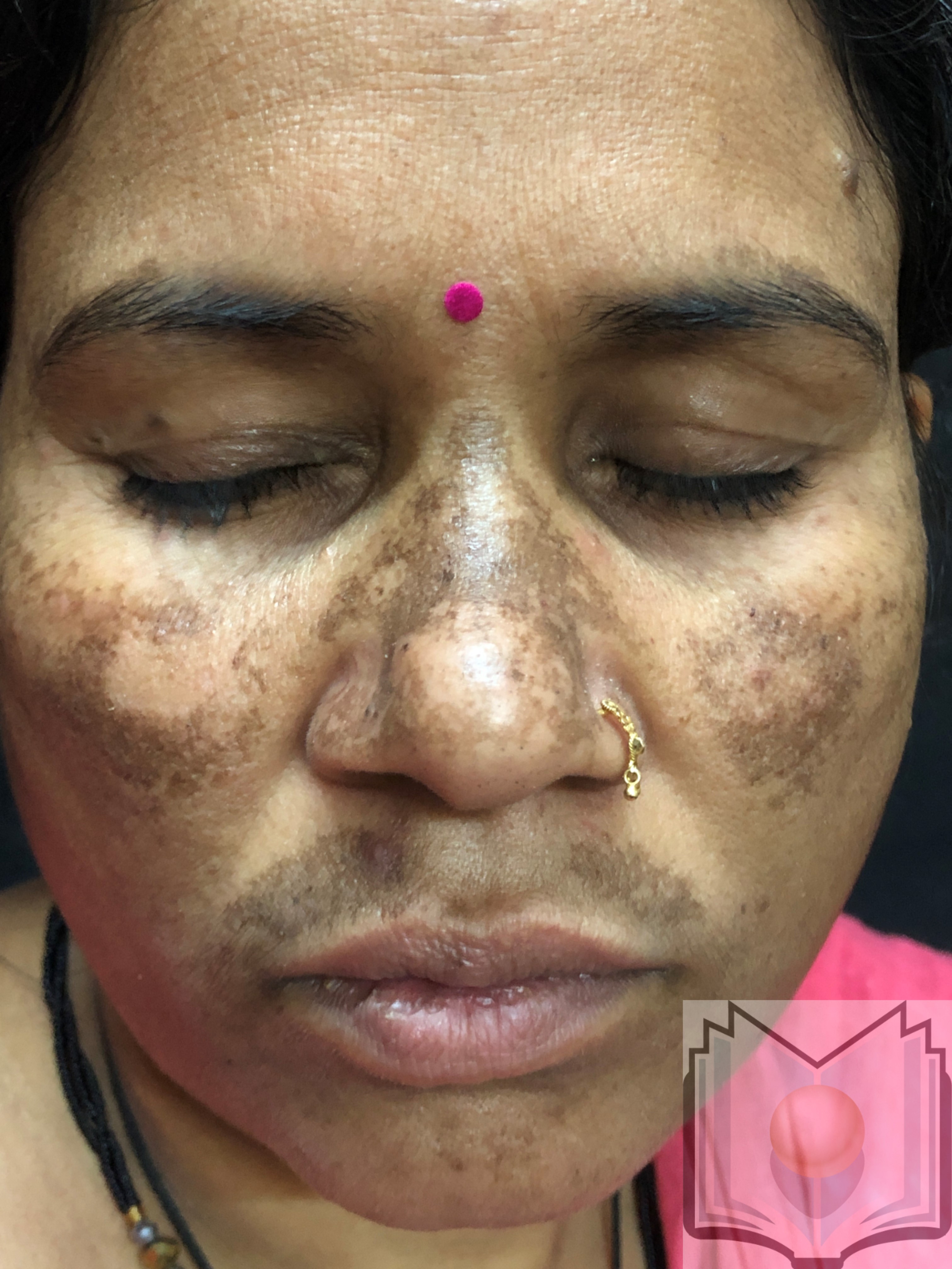 Melasma  on the face