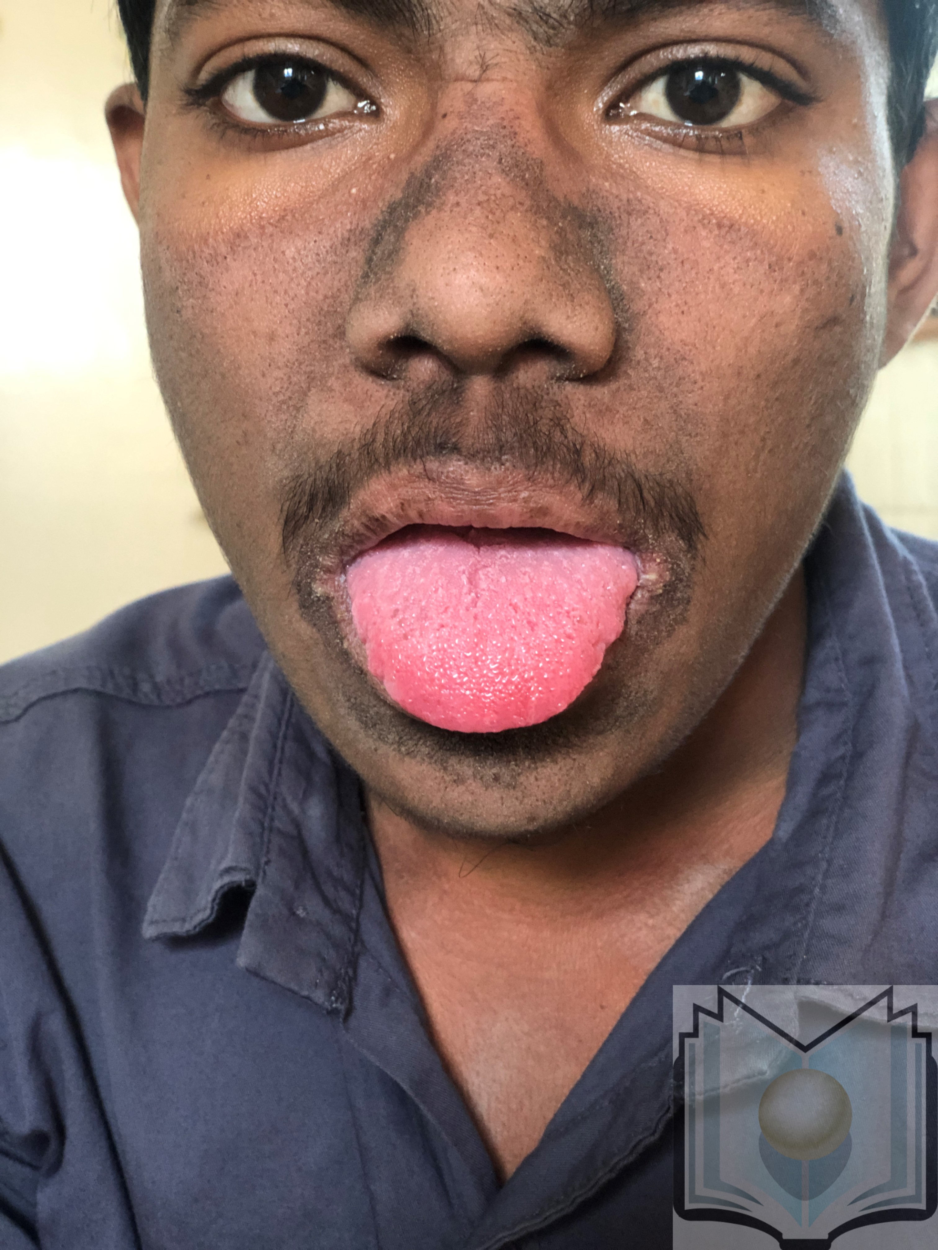 Pellagra Tongue