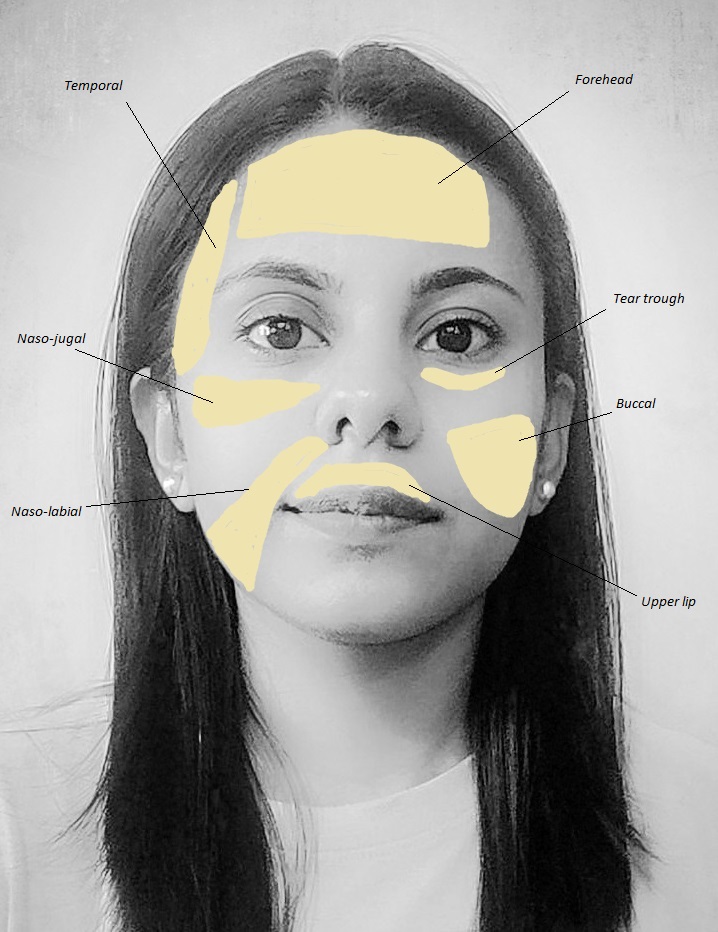Most common areas of face used for fat grafting 