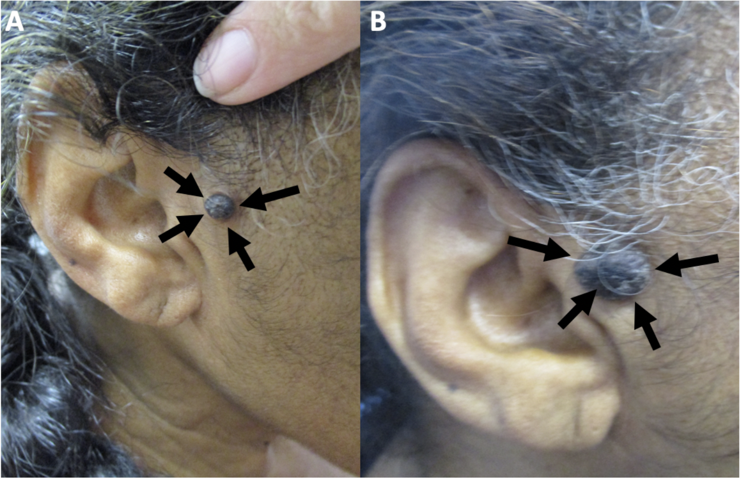 <p>Cutaneous Melanoacanthoma on the Right Preauricular Cheek