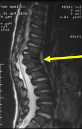 Congenital kyphosis MRI 