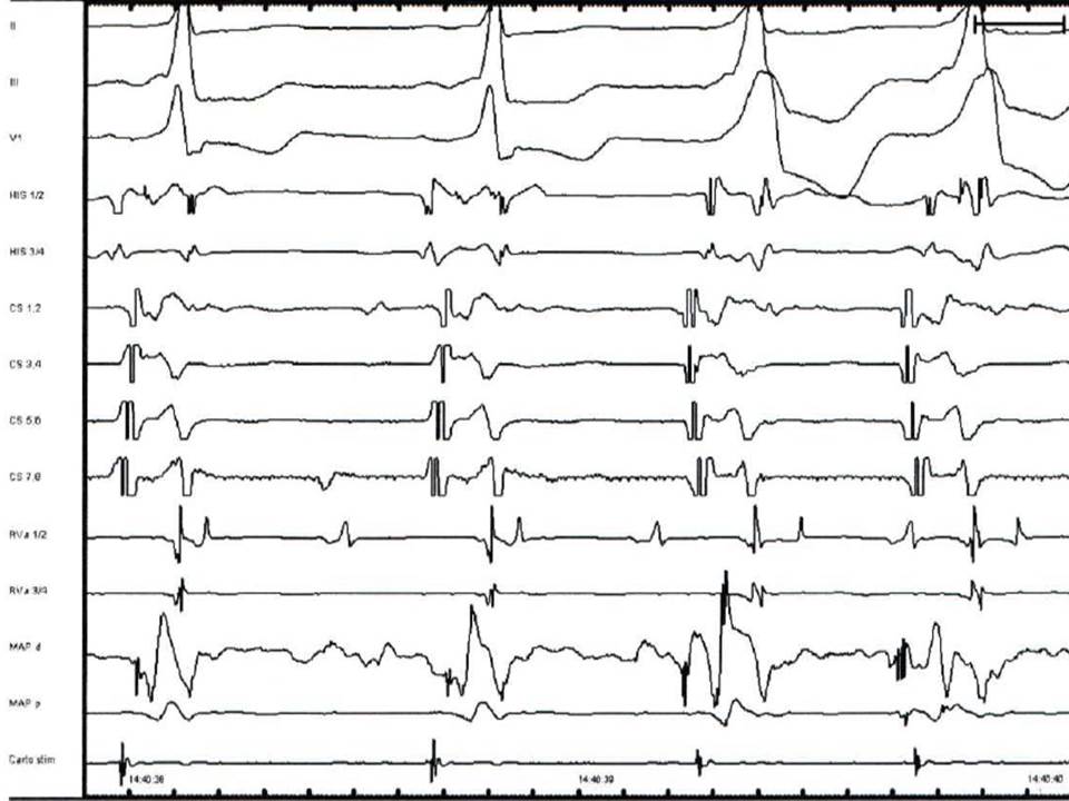 Interpretation of electrophysiologic testing. Quiz. Question 1