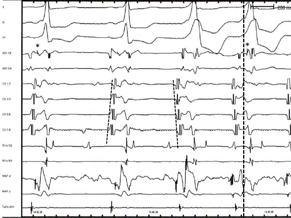 Interpretation of electrophysiologic testing. Quiz. Answer to question 1. 

The EPS establishes the diagnosis of preexcitation due to a left-sided accessory pathway. 
The two initial sinus beats are not fully preexited while the preexcitation of the third and the fourth left atrial extrasystoles (earliest atrial activation in CS 1,2) is complete.  Typical findings include the wide positive QRS in lead V1, the earliest ventricular activation with fusion of  A and V signals observed in the distal coronary sinus (CS 1,2) and the negative HV interval (meaning that the beginning of QRS precedes the His bundle signal)  in the fully preexited in the third and fourth beat (His bundle signal denoted with an asterisk

