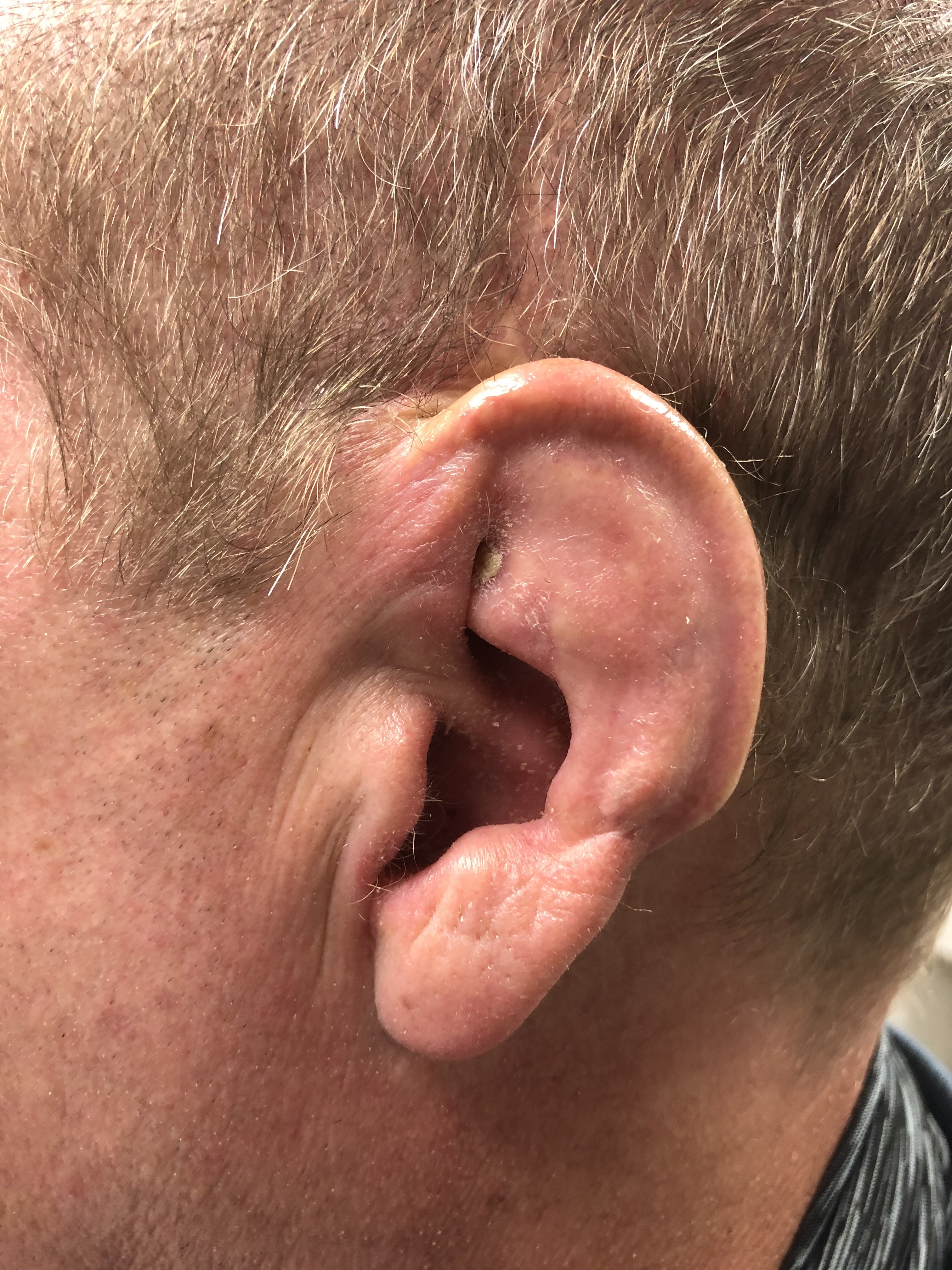 <p>Mild Cauliflower Ear