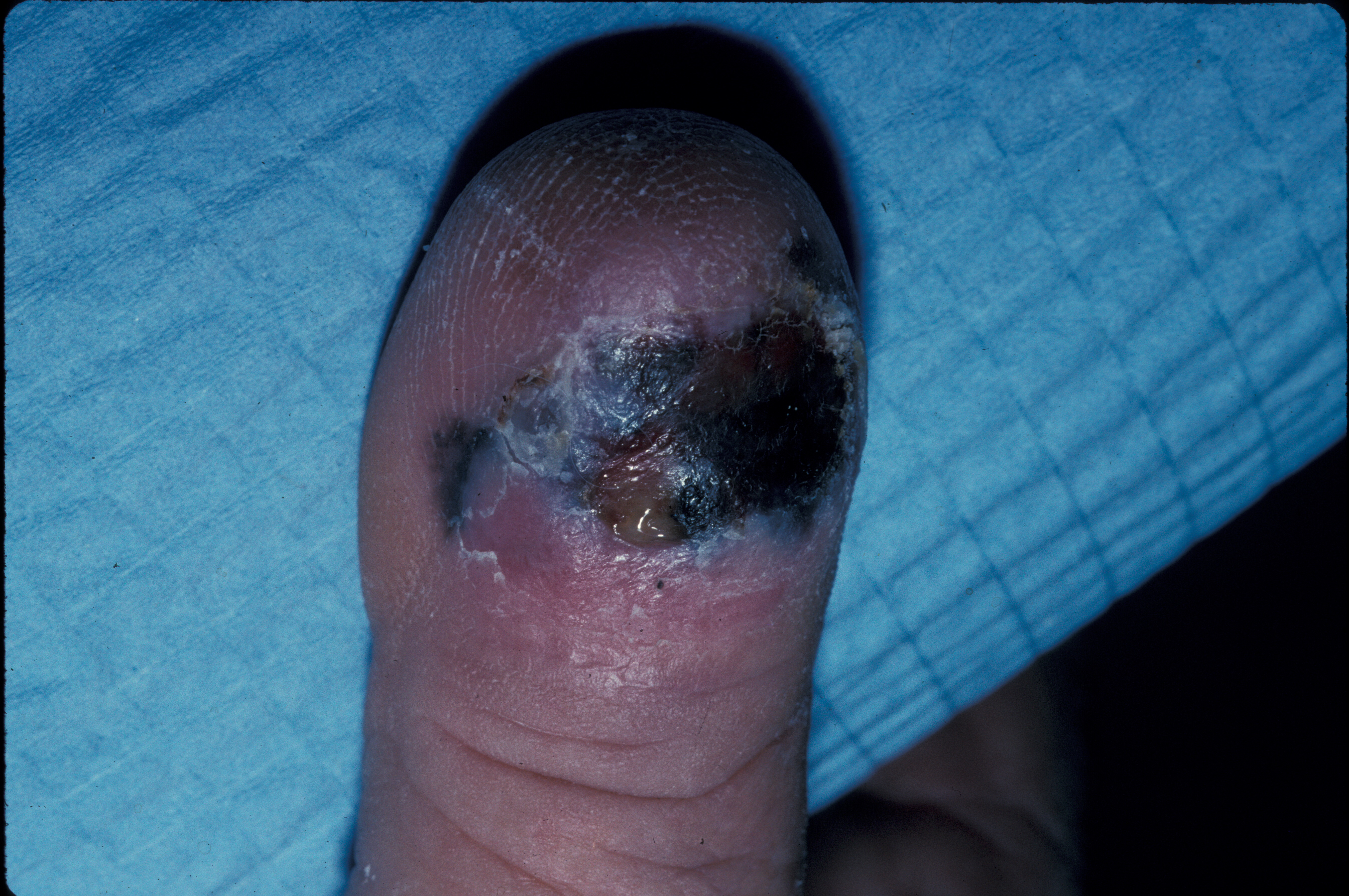 Clinical photo of an ulcerated acral lentiginous melanoma on the dorsal aspect of a toe. 