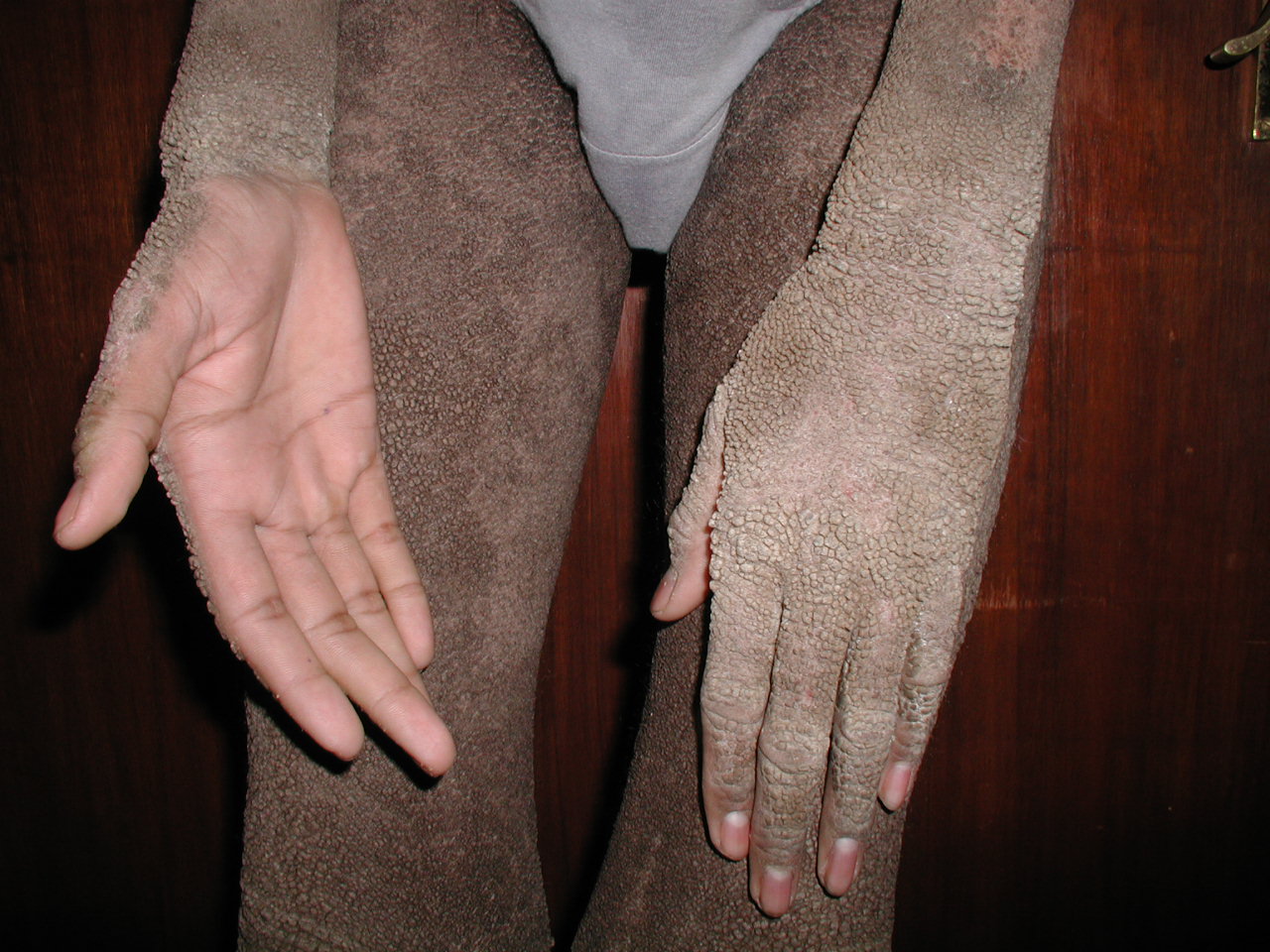 <p>Hyperkeratosis in Epidermolytic Hyperkeratosis