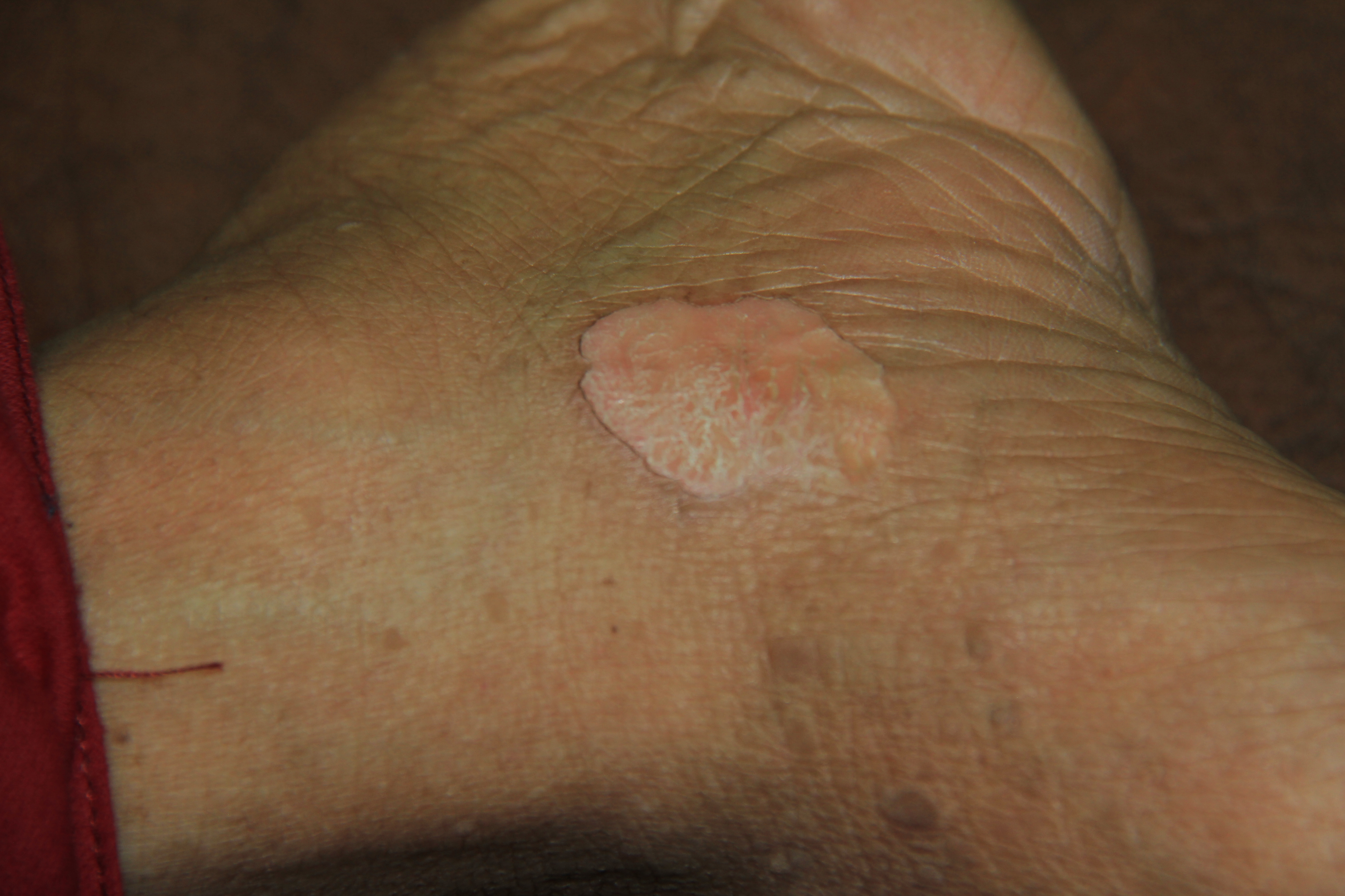 Porokeratosis of Mibelli