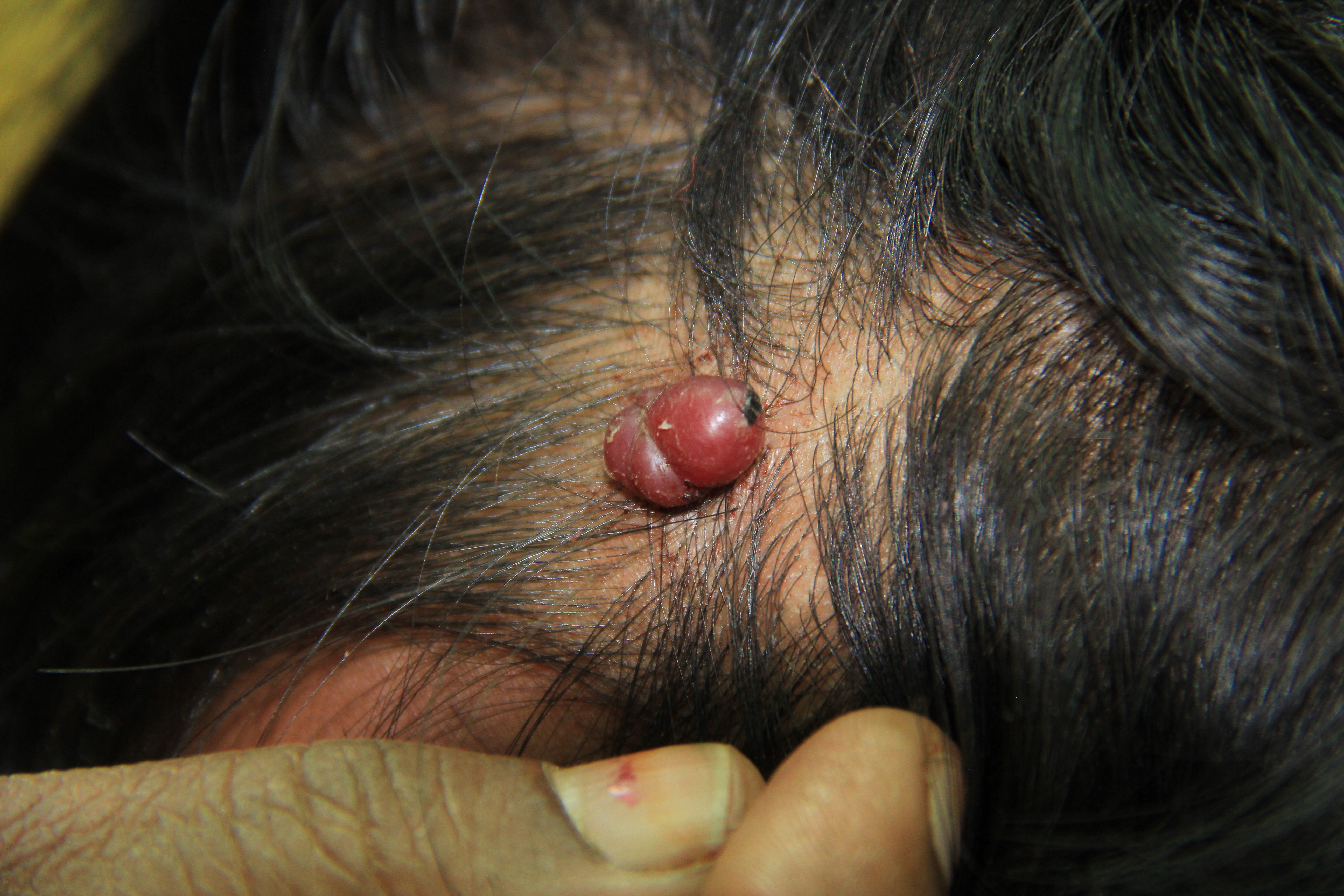 <p>Pyogenic Granuloma, Scalp