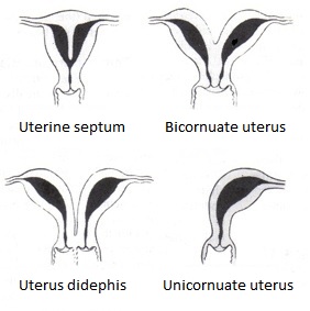 <p>Types of Bicornuate Uterus Malformation