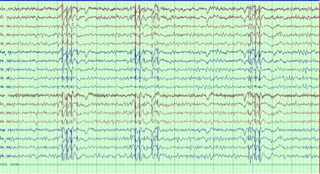 Fig 1
EEG showing 3-3.5 Hz Generalized Spike and wave and polyspike and wave discharges